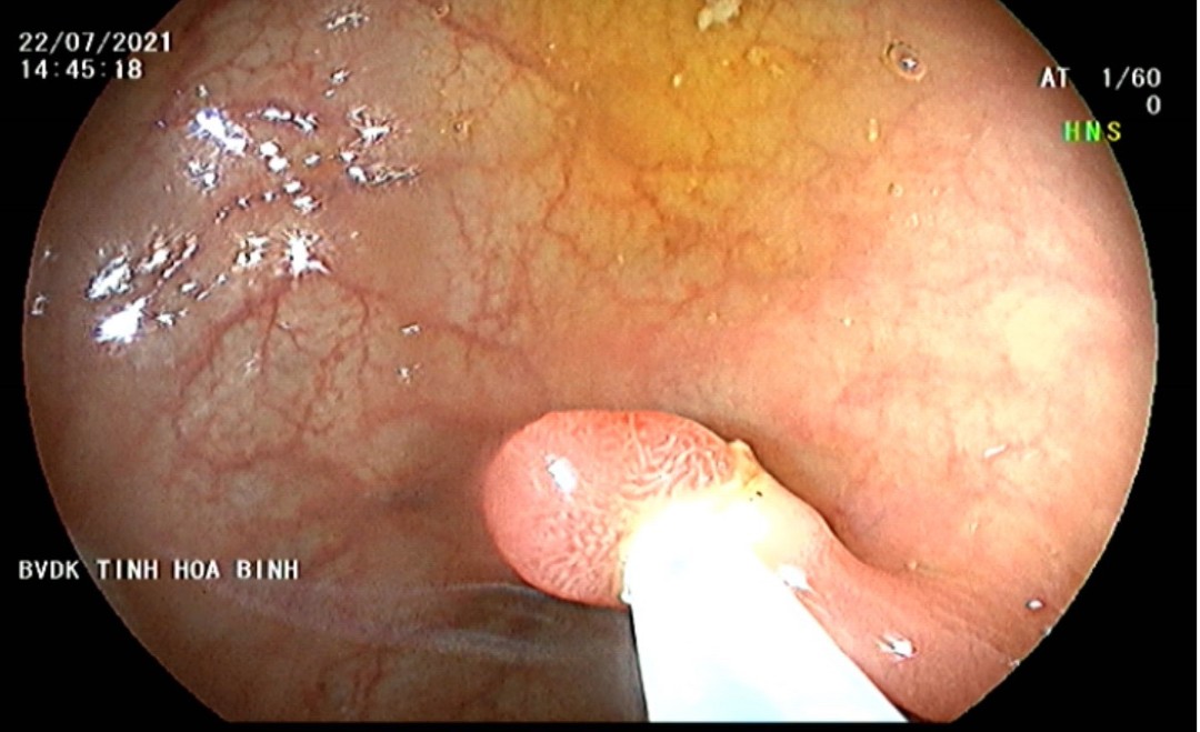 Phát hiện sớm polyp để ngăn chặn ung thư đại, trực tràng 