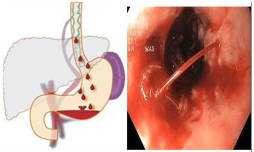  Chảy máu đường tiêu hóa trên ở bệnh nhân xơ gan có tăng áp lực tĩnh mạch cửa