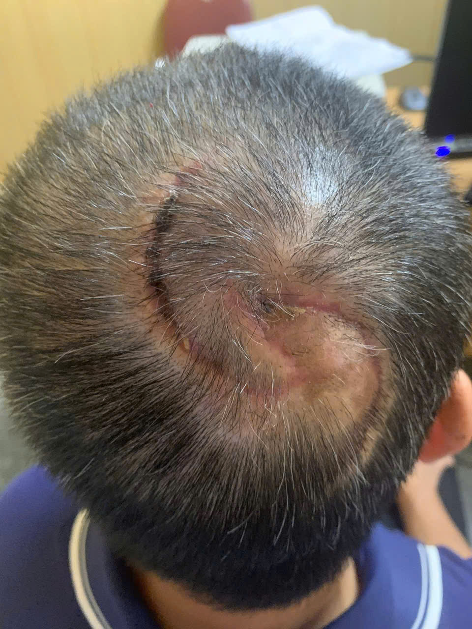  Điều trị kết hợp thẩm mỹ các chấn thương sọ não – Đáp ứng nhu cầu ngày càng cao trong chăm sóc sức khỏe nhân dân