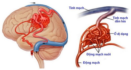  Đau đầu cần chú ý tới dị dạng mạch máu não