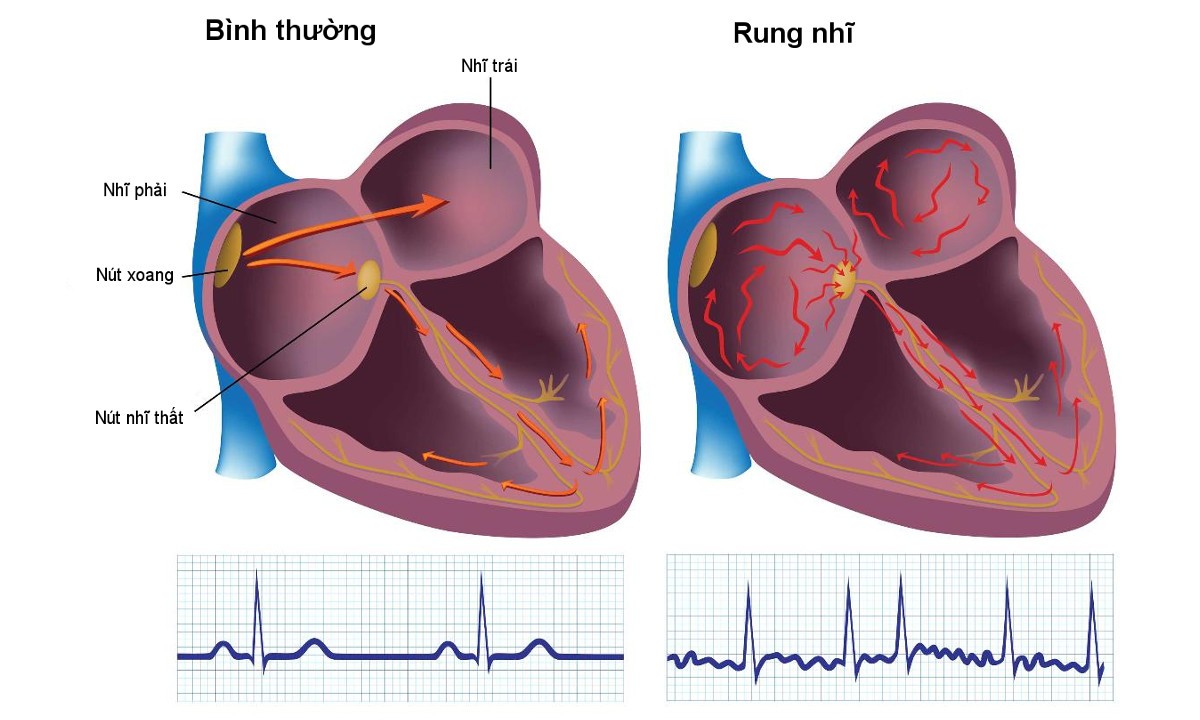  Tìm hiểu về bệnh rung nhĩ - Rối loạn nhịp tim nguy hiểm thường gặp